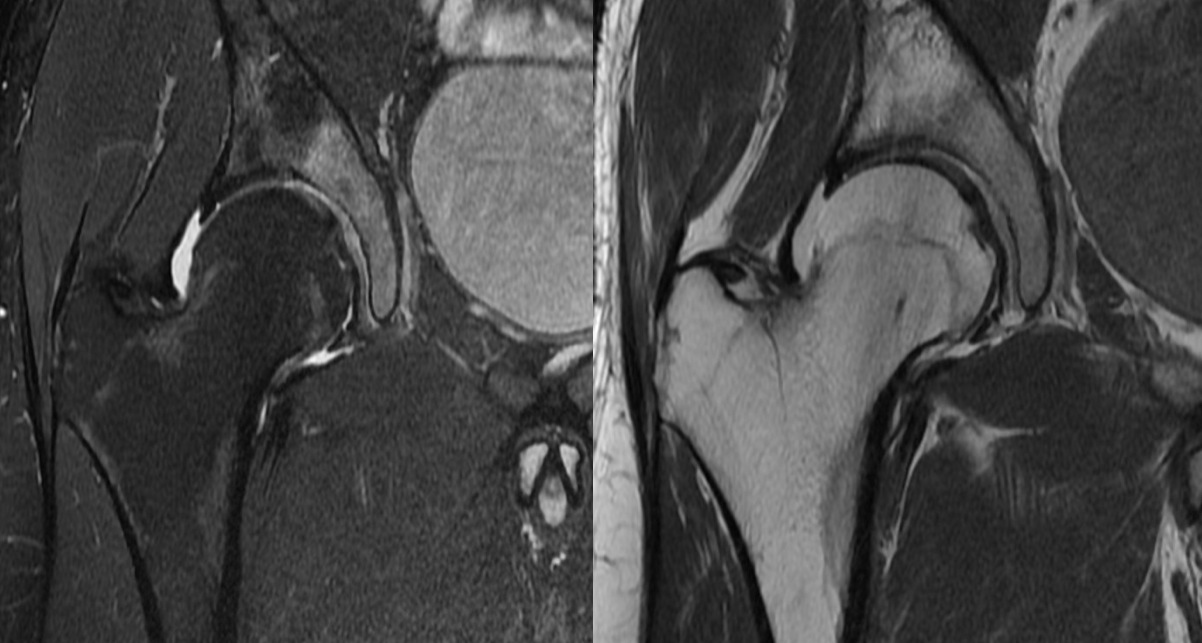 Figure 2 for case Osteoid osteoma ( RID4005 )